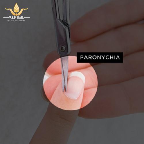 bệnh về móng và cách xử lý - baogiadinh.vn
