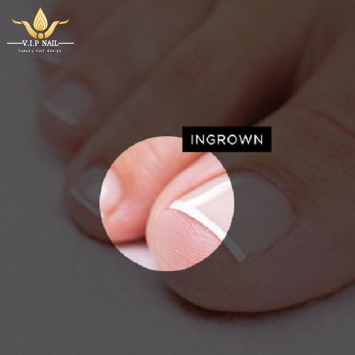 bệnh về móng và cách xử lý - baogiadinh.vn