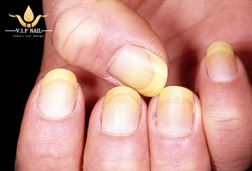 Móng tay ngả vàng là điều không bình thường - baogiadinh.vn