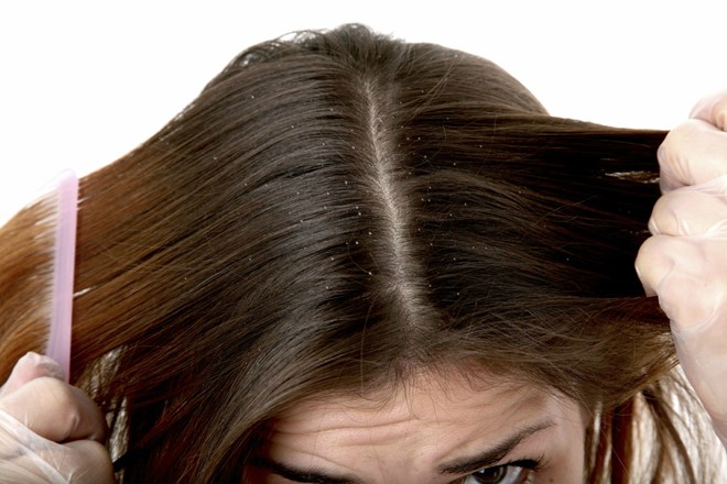 Chăm sóc tóc khỏe nhờ dầu trị gàu hiệu quả