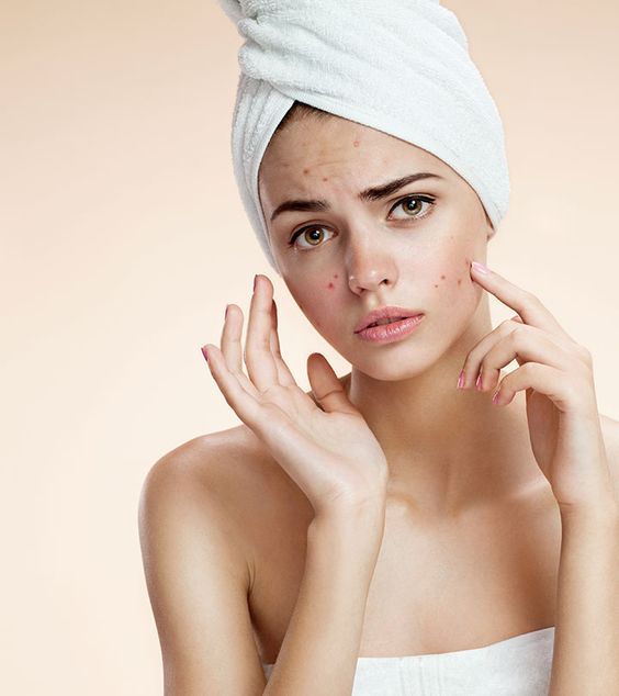 Nên làm gì khi chăm sóc da mặt mụn và sẹo thâm hiệu quả