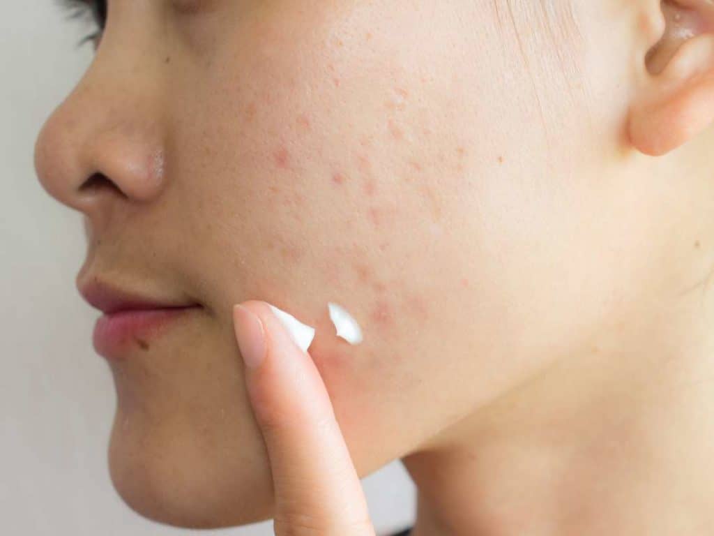 Cách chăm sóc da mặt trị mụn