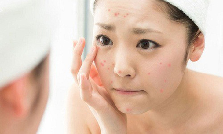 Chăm sóc da mặt trị mụn ngăn vết thâm và không bị rỗ